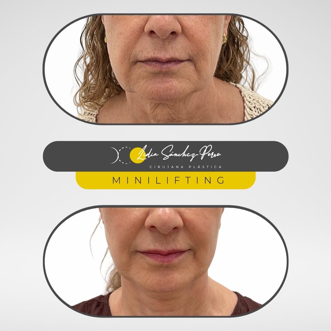minilifting facial en barcelona